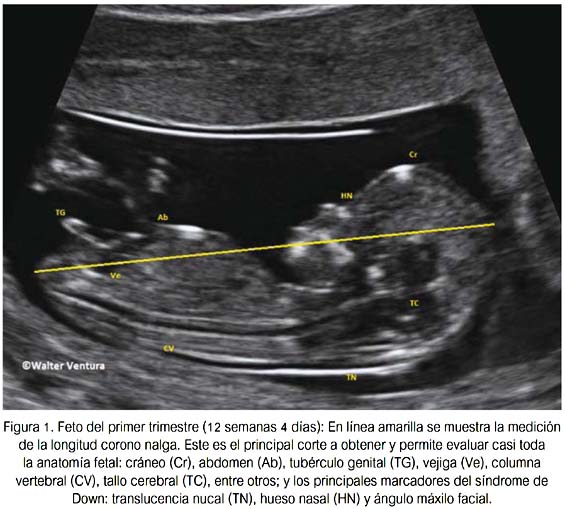 La importancia de la ecografía a las 11+0 a 13+6 semanas de