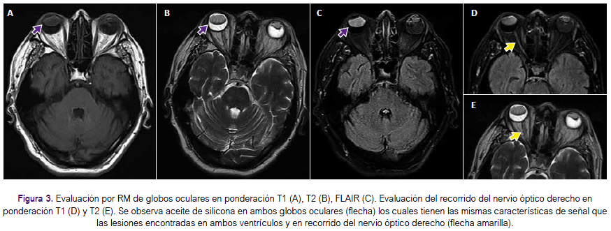 Aceites de silicona, Retina