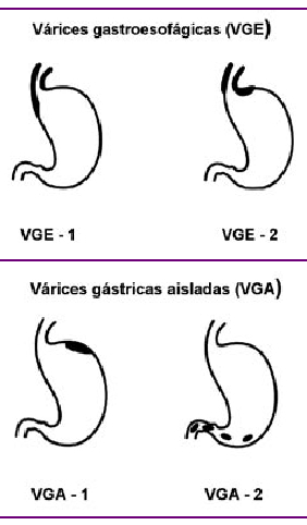 Segmental vene varicoase, Forma reticulară