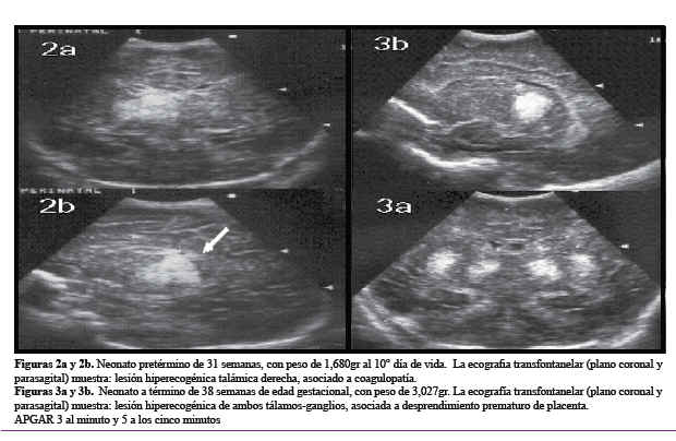 Clasificacion De Asfixia Perinatal Pdf