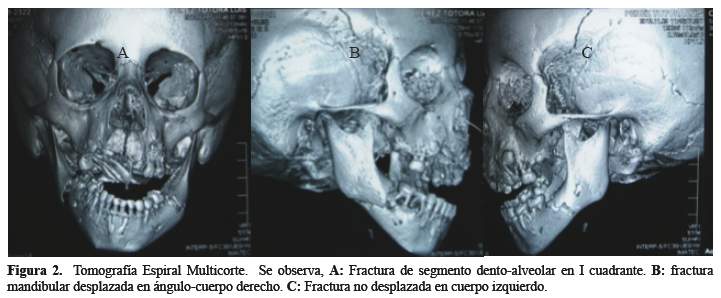 Radiografia de maxilar y mandibula