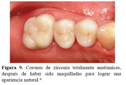 Corona Metal Porcelana Convencional