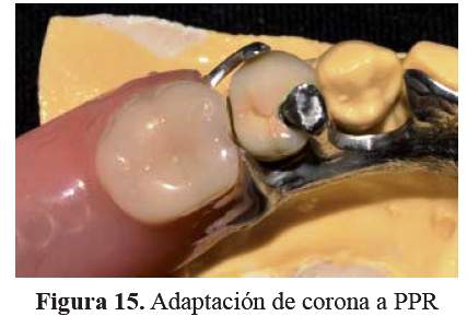 Adaptación de una corona metal cerámica como pilar de una prótesis parcial  removible preexistente