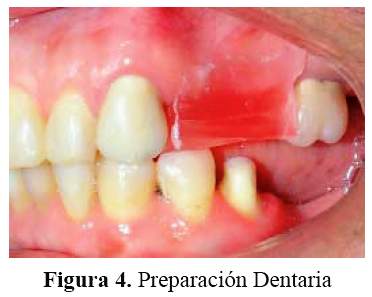 Corona dental de metal (níquel-cromo) –