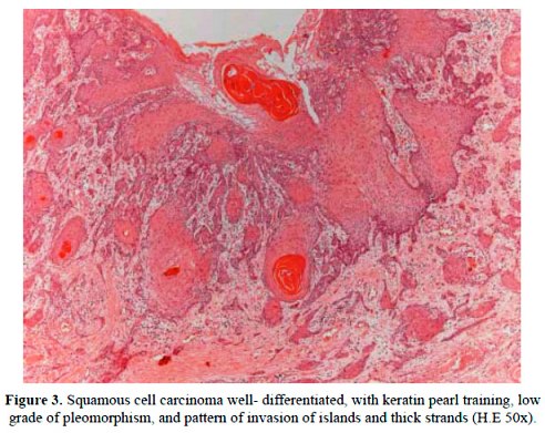 El diagnóstico y tratamiento de enfermedades de la mujer. Fig. 270.  Carcinoma]de Labium Minus, comienzo. (Hirst, enfermedades ofWomen.)  CARCINOMA DE LABIUM 205. Fig. 271. Carcinoma de Labium en un escenario  mayor.(Hirst