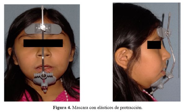 Máscara facial: A) modelo de Delaire y cols(2), B) modificación de Petit(3)