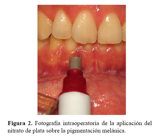 Nitrato de plata y despigmentación gingival de manchas melánicas: un  reporte de caso