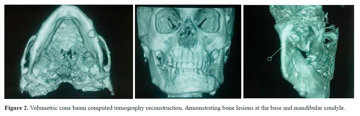 Osteoma de mandíbula: relato de caso