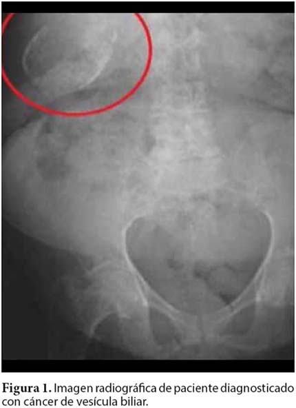 cancer vesicula biliar diagnostico