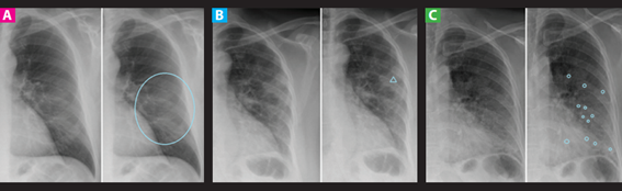 Radiografía de tórax en un paciente con enfermedad de Niemann Pick