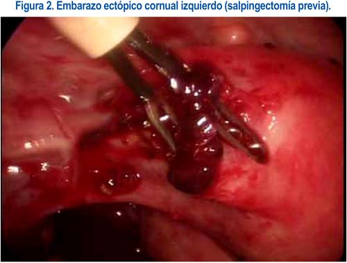 HC - LABREPTransmigração de gametas. Estudo da salpingectomia