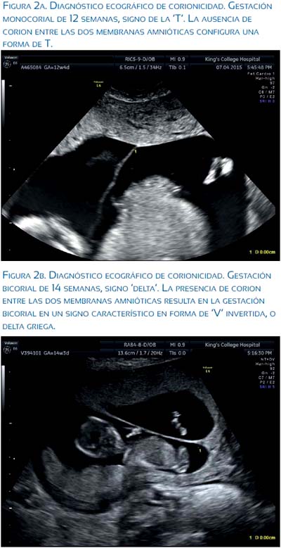 Embarazo positivo sin saco gestacional 2025