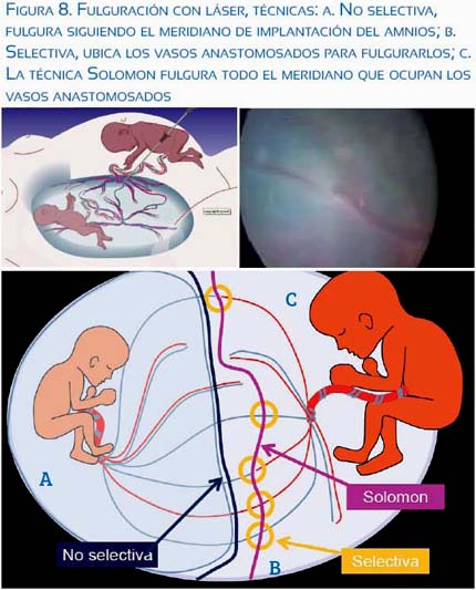 tratamiento de la transfusión feto fetal con técnica de Salamon