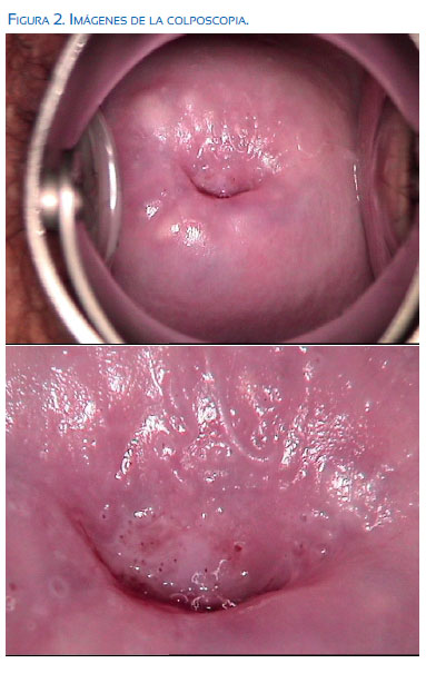 virus del papiloma y colposcopia