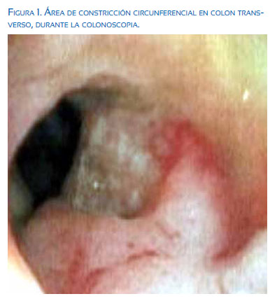 endometrial cancer in colon