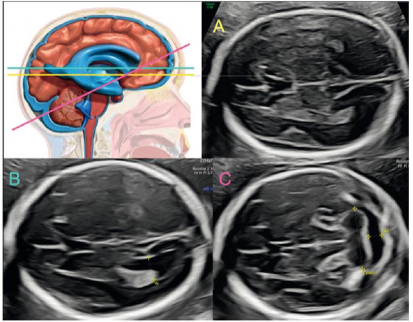 Use of MRI in the diagnosis of fetal brain abnormalities in utero  (MERIDIAN): a multicentre, prospective cohort study - The Lancet