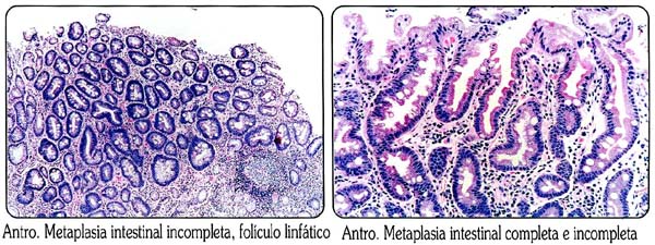 metaplasia