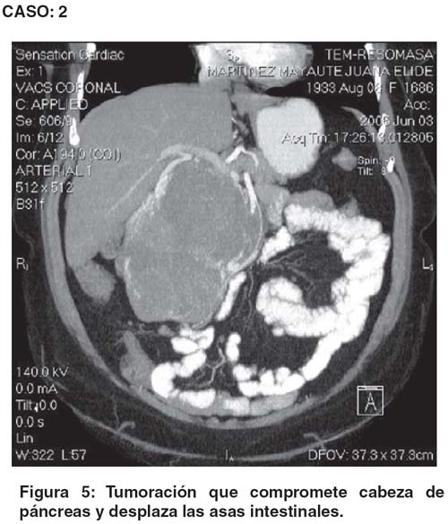 Cistadenoma Seroso
