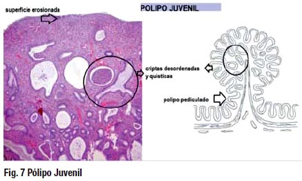 Pólipos colorectales: actualización en el diagnóstico