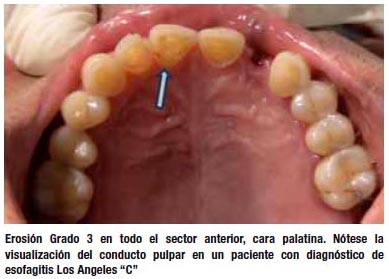 que significa esofagitis grado b de los angeles