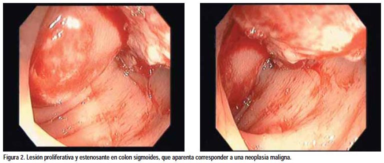 endometrial cancer in colon