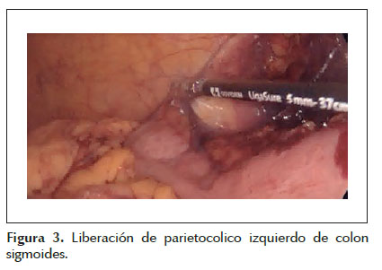 cancer colon laparoscopia cancerul mamar proiect