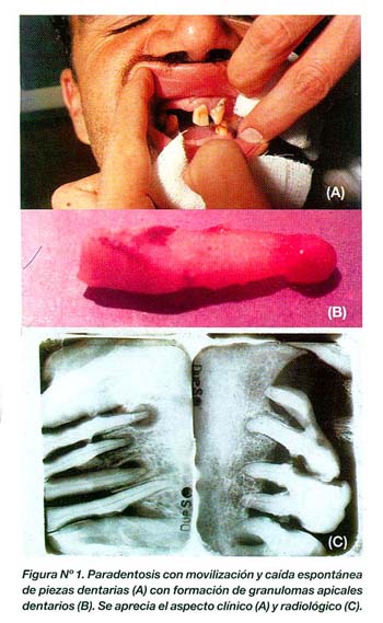 Blastomicosis Pulmonar Pdf