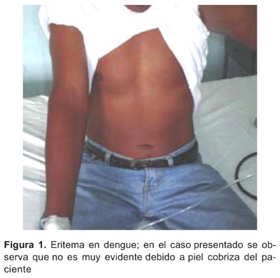 Caso de Dengue Hemorrágico en Iquitos Caso de Dengue Hemorrágico en Iquitos