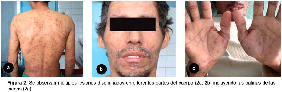 Sífilis secundaria en un paciente viviendo con VIH Sífilis secundaria en un paciente viviendo con VIH