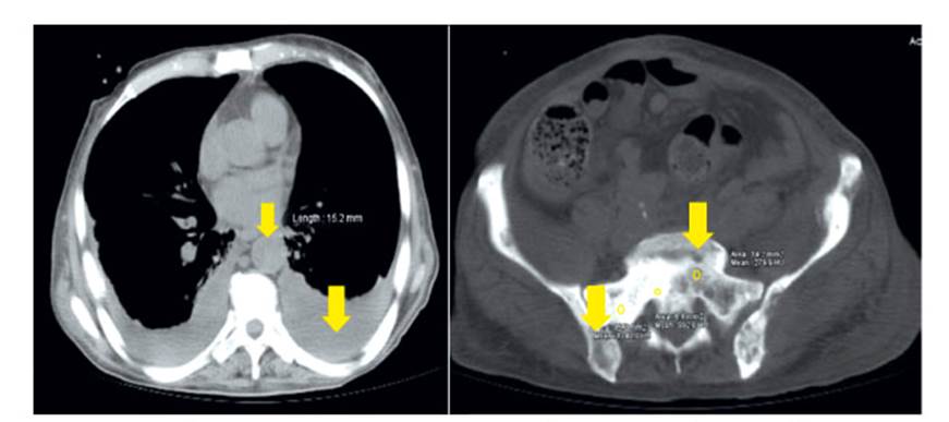 cáncer de próstata metástasis pulmonar