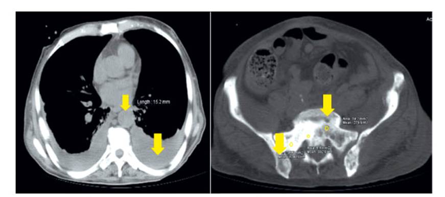 cáncer de próstata scielo)