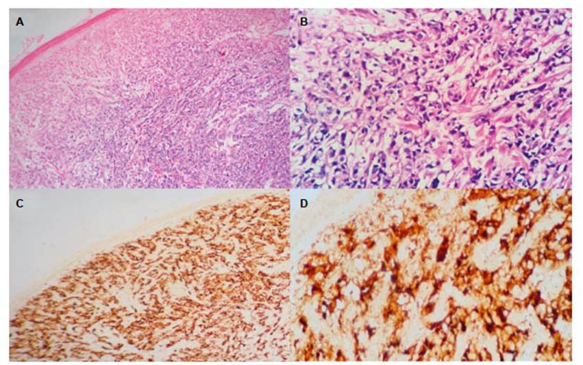 cancer de prostata scielo