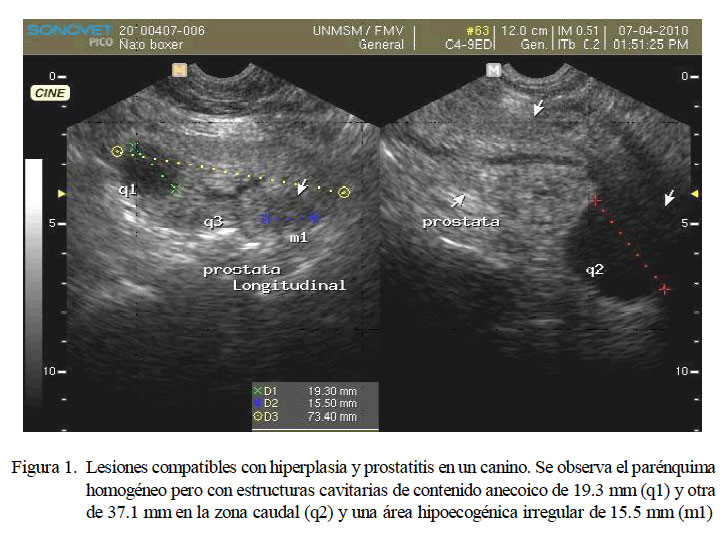 ecografia prostata adenoma