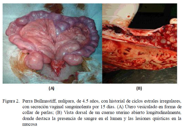 Qué pasa si tengo hiperplasia endometrial