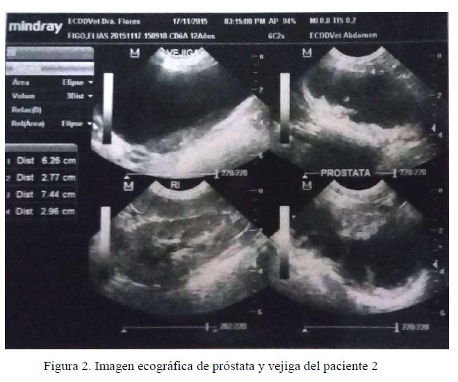 μb krónikus prosztatitis exacerbation