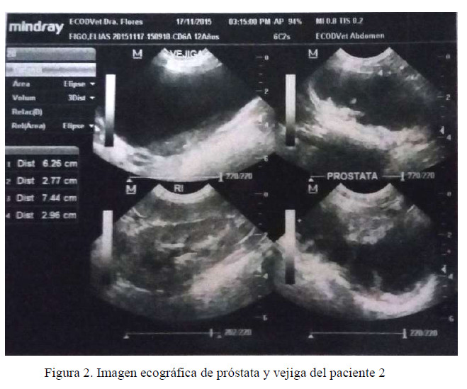 prostatitis 2 fokozat)