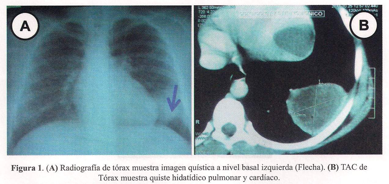 Resultado de imagen de quiste hidatidico perro