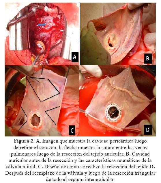 venas pulmonares auricula izquierda