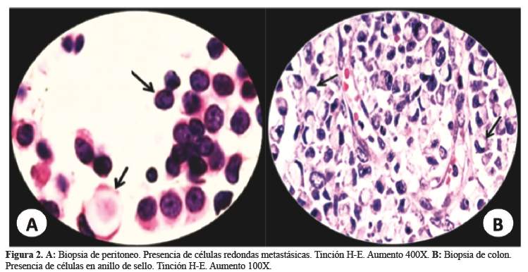 Automático O después Padre fage Carcinomatosis peritoneal secundaria a adenocarcinoma de células en anillo  de sello del colon: A propósito de un caso